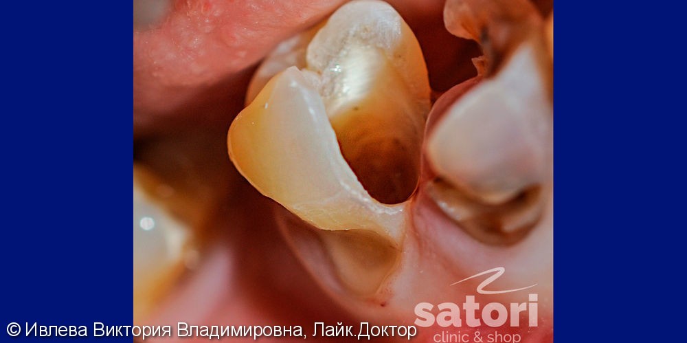 Лечение пульпита в зубе 4.5 (нижний зуб справой стороны) - фото №1