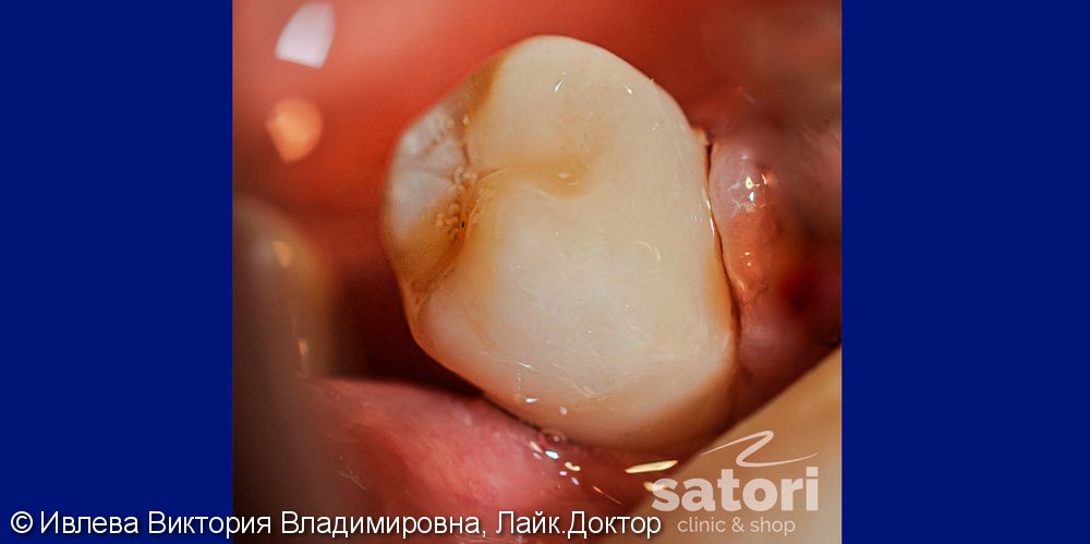 Лечение пульпита в зубе 4.5 (нижний зуб справой стороны) - фото №2