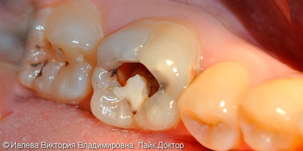 Лечение глубокого кариеса зуба 3.6, до и после лечения - фото №1