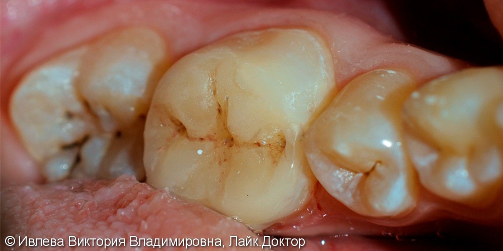 Лечение глубокого кариеса зуба 3.6, до и после лечения - фото №2