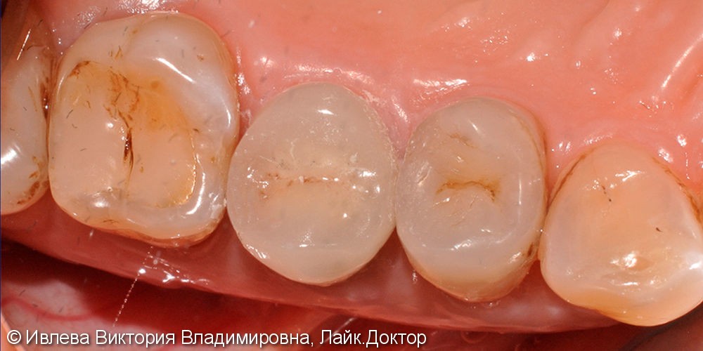 Ортопедическое восстановление зуба 1.5 металлокерамической коронкой - фото №2