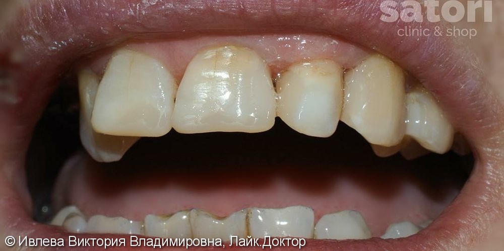 Восстановление зубов при помощи светоотверждаемого композитного материала - фото №2