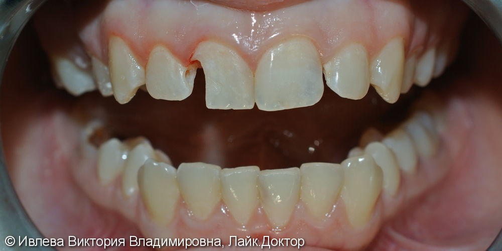 Лечение кариеса зубов 1.2, 1.1 - фото №1