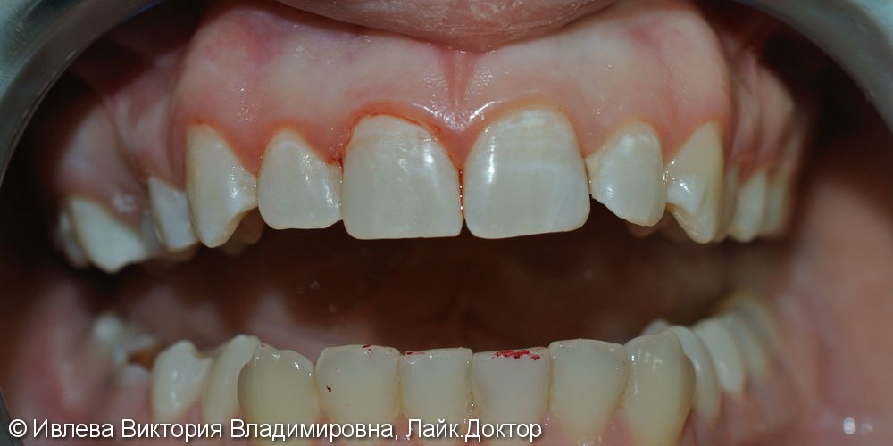 Лечение кариеса зубов 1.2, 1.1 - фото №2
