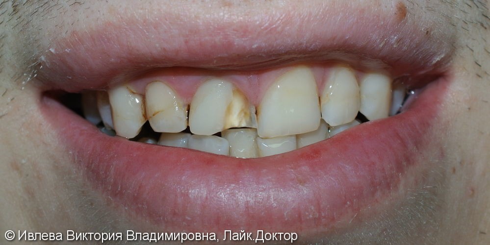 Лечение вторичного кариеса зуба 1.1 - фото №1