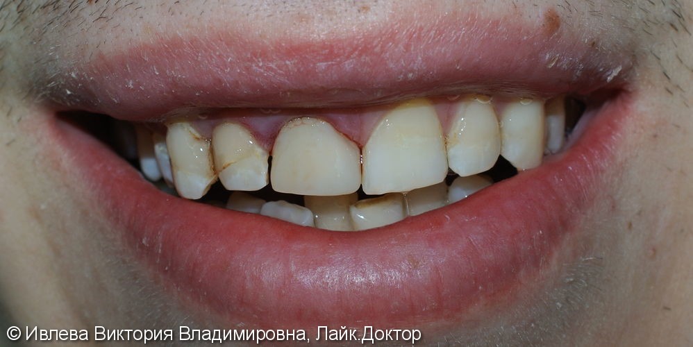 Лечение вторичного кариеса зуба 1.1 - фото №2