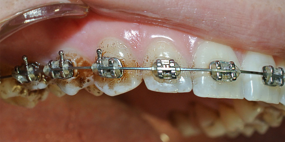 Снятие минерализованных и неминерализованных наддесневых зубных отложений - фото №1