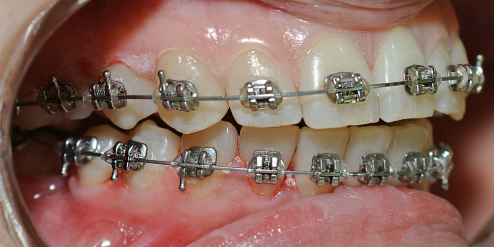 Снятие минерализованных и неминерализованных наддесневых зубных отложений - фото №2