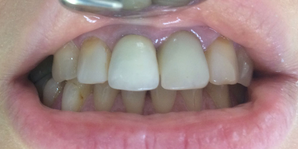 Жалобы на неудовлетворительную эстетику передних зубов: цвет и форма - фото №1