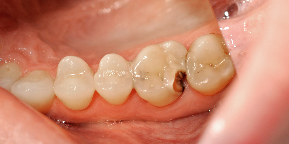 Результат лечения кариеса и замены пломбы, зуб 2.6 - фото №1
