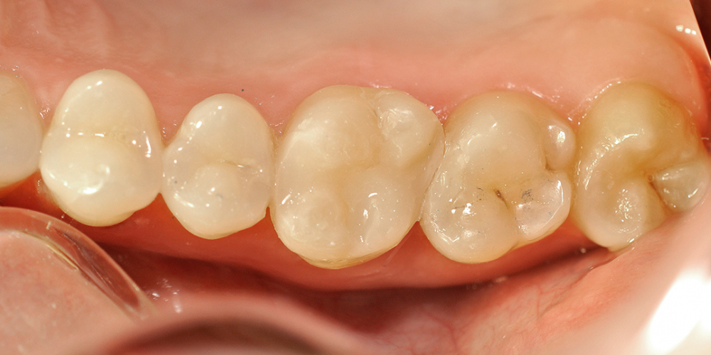 Результат лечения кариеса и замены пломбы, зуб 2.6 - фото №2
