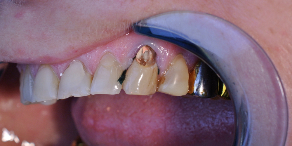 Пациентка обратилась с жалобами на боль в зубе и скол пломбы - фото №1