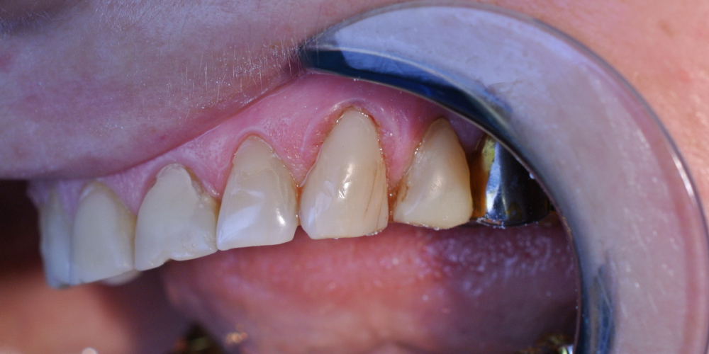 Пациентка обратилась с жалобами на боль в зубе и скол пломбы - фото №2