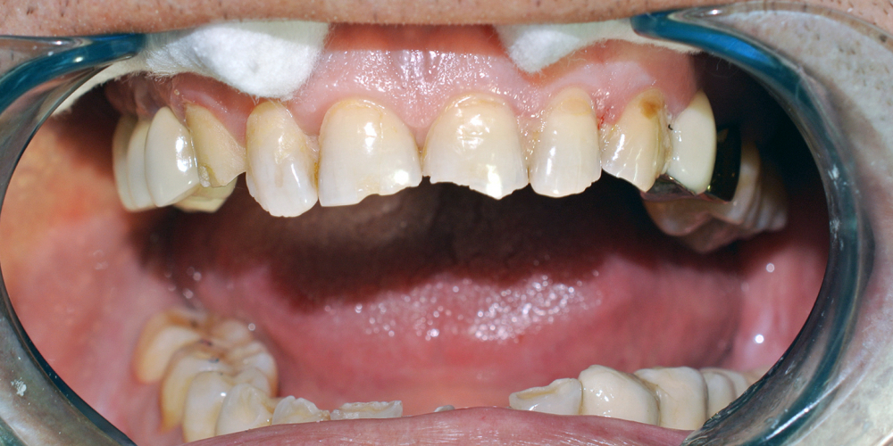 Восстановление фронтальной группы зубов пломбой - фото №1