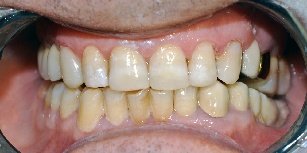 Восстановление фронтальной группы зубов пломбой - фото №2