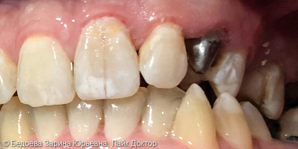 Восстановление зуба 2.3 металлокерамической коронкой - фото №1