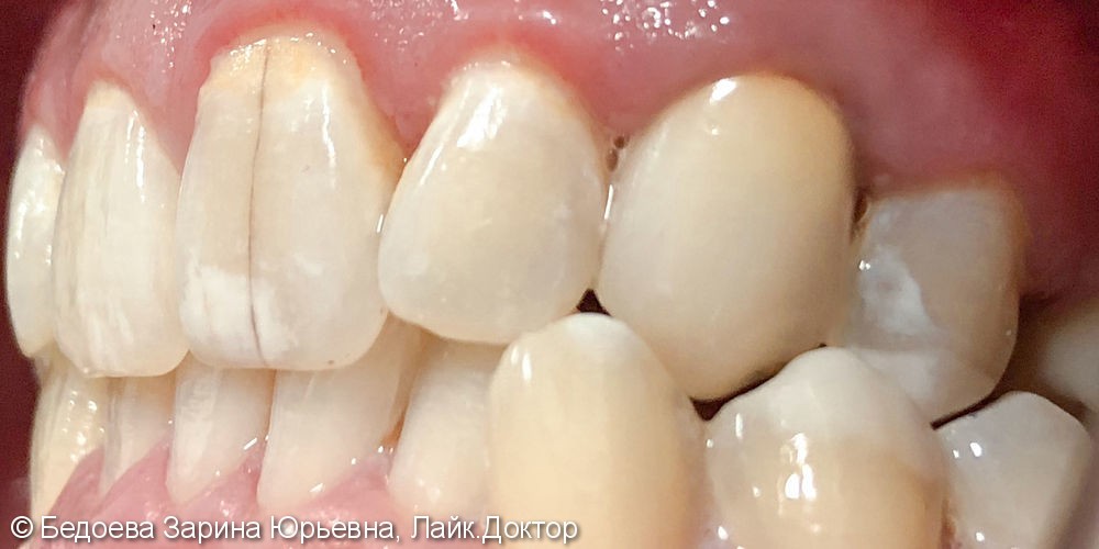 Восстановление зуба 2.3 металлокерамической коронкой - фото №2