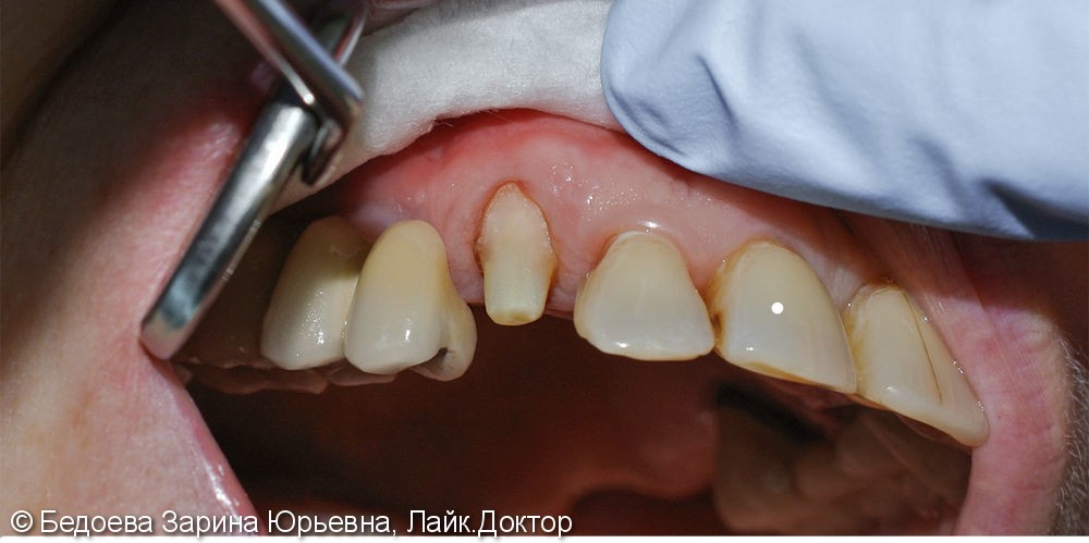 Протезирование зуба 1.3 керамической коронкой на оксиде циркония - фото №1