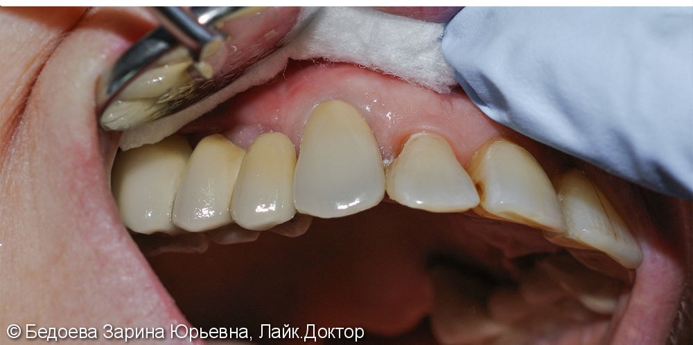 Протезирование зуба 1.3 керамической коронкой на оксиде циркония - фото №2