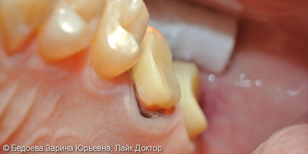 Протезирование жевательных зубов коронками из оксида циркония - фото №1