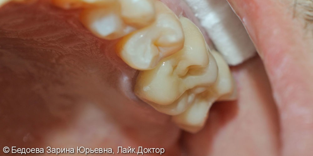 Протезирование жевательных зубов коронками из оксида циркония - фото №2