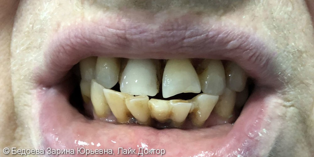 Протезирование зубов металлокерамическими коронками, до и после - фото №1