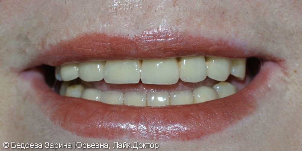 Протезирование зубов металлокерамическими коронками, до и после - фото №3