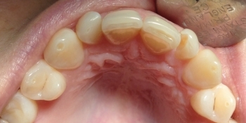 Лечение кариеса переднего зуба - фото №1