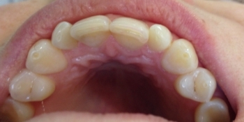 Лечение кариеса переднего зуба - фото №3