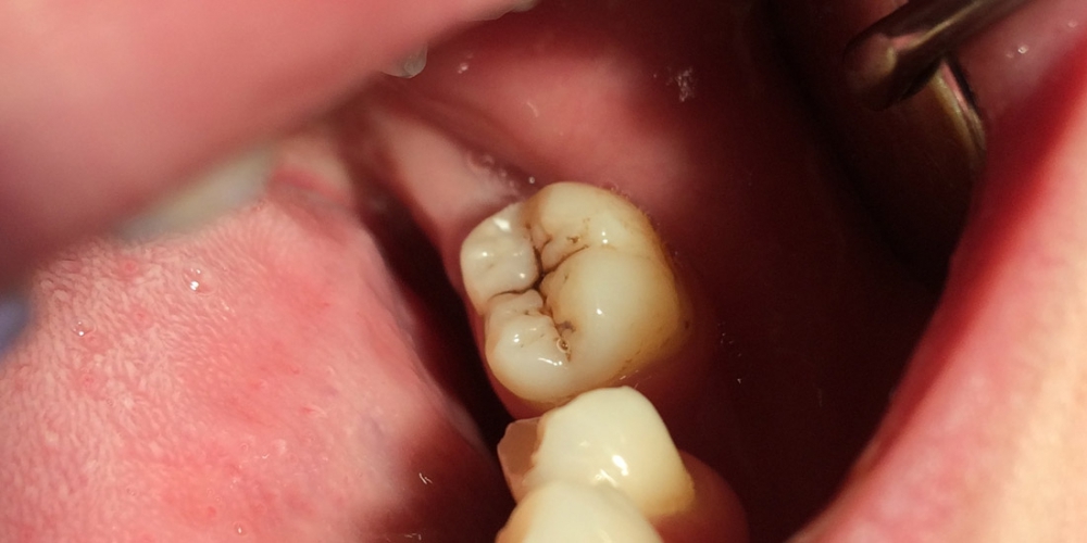Результат лечения кариеса жевательного зуба 3.7 - фото №1