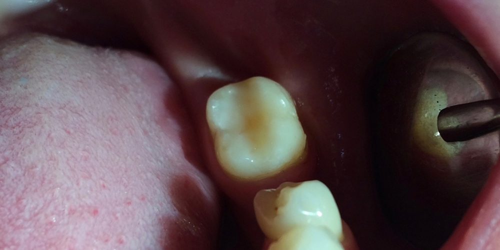 Результат лечения кариеса жевательного зуба 3.7 - фото №3