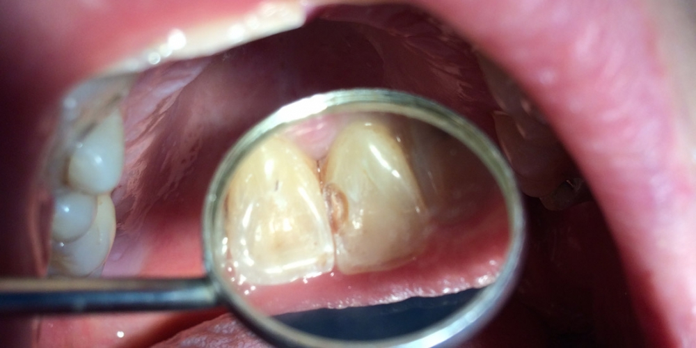 Результат замены пломбы на переднем зубе - фото №1