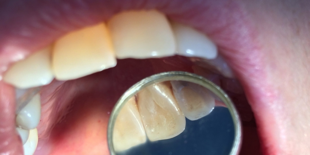 Результат замены пломбы на переднем зубе - фото №2