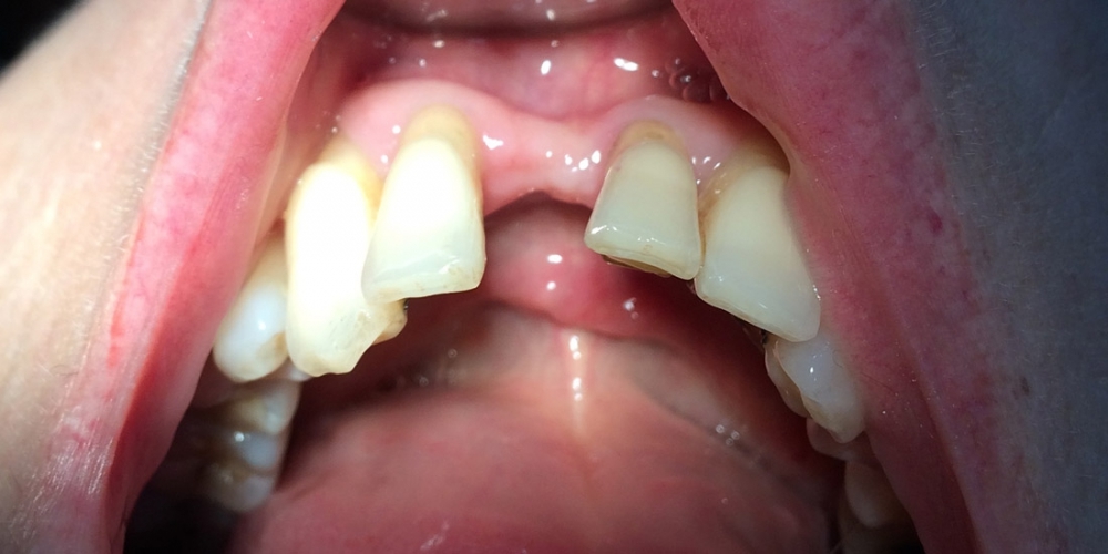 Шинирование переднего зуба (замещение временным зубом) - фото №1