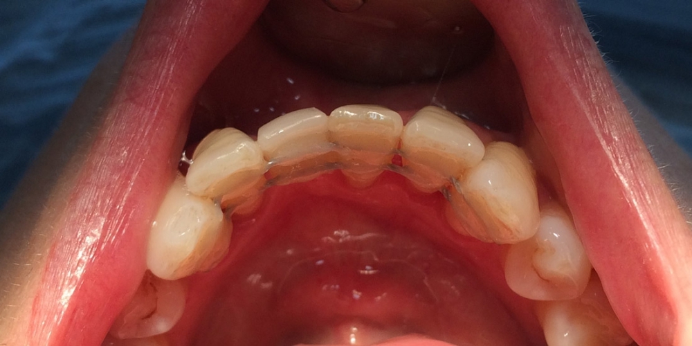 Шинирование переднего зуба (замещение временным зубом) - фото №2