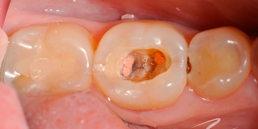 Самопроизвольные длительные ноющие боли в зубе 46 - фото №1