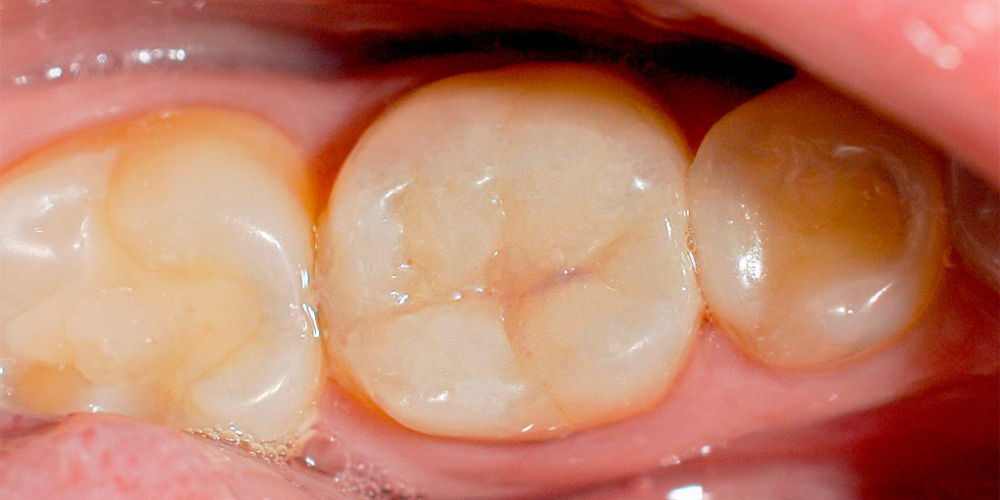 Самопроизвольные длительные ноющие боли в зубе 46 - фото №2
