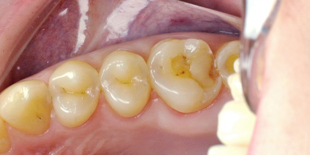Жалобы на болевые ощущения в 17 зубе от холодных температурных раздражителей - фото №1