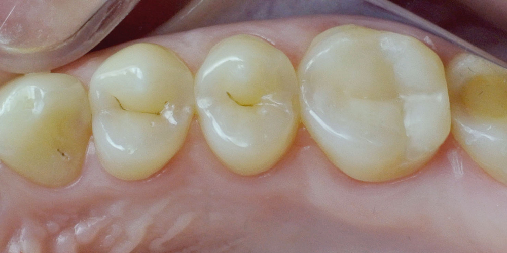 Жалобы на болевые ощущения в 17 зубе от холодных температурных раздражителей - фото №2