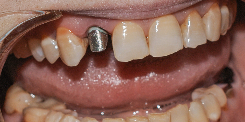 Восстановление зуба металлокерамической коронкой Noritake, Япония - фото №1