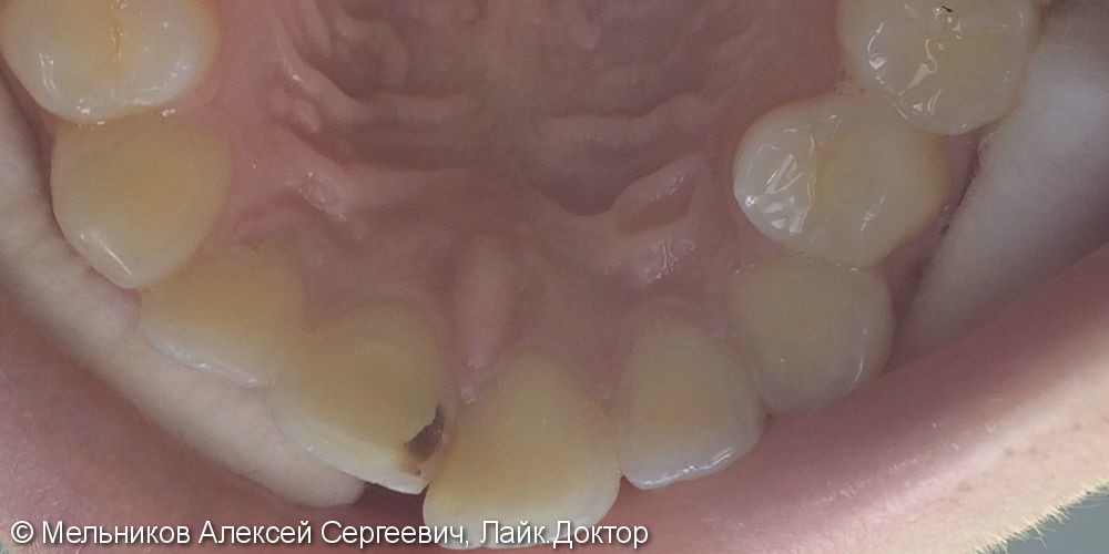 Лечение глубокого кариеса зуба 2.1 - фото №1