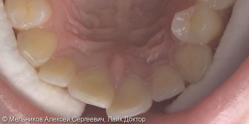 Лечение глубокого кариеса зуба 2.1 - фото №2