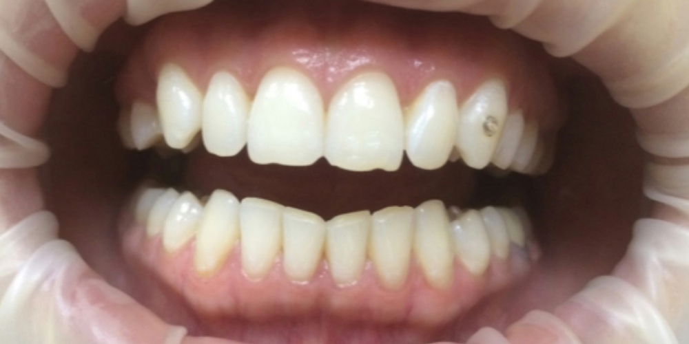Отбеливание зубов системой Opalescence Boost PF - фото №1