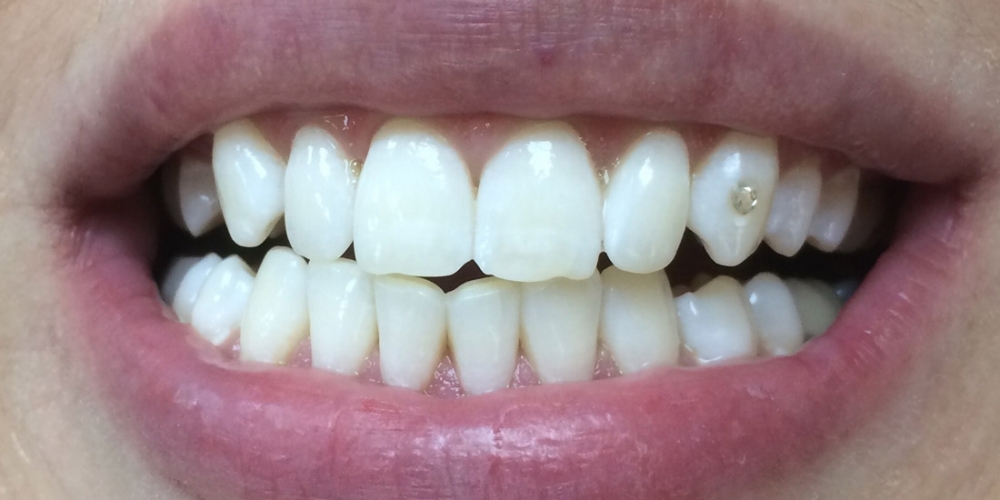 Отбеливание зубов системой Opalescence Boost PF - фото №2