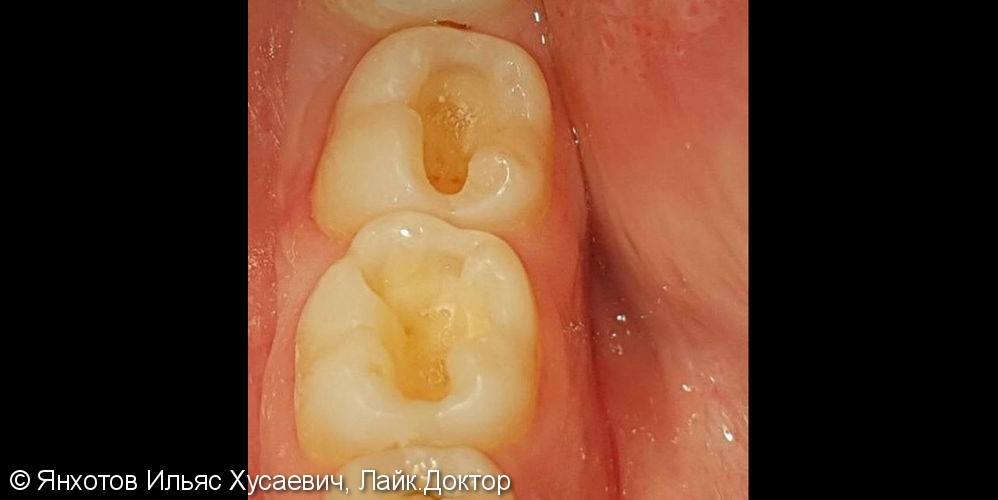 Глубокая кариозная полость зубов 4.6 и 4.7 фотографии до и после - фото №2