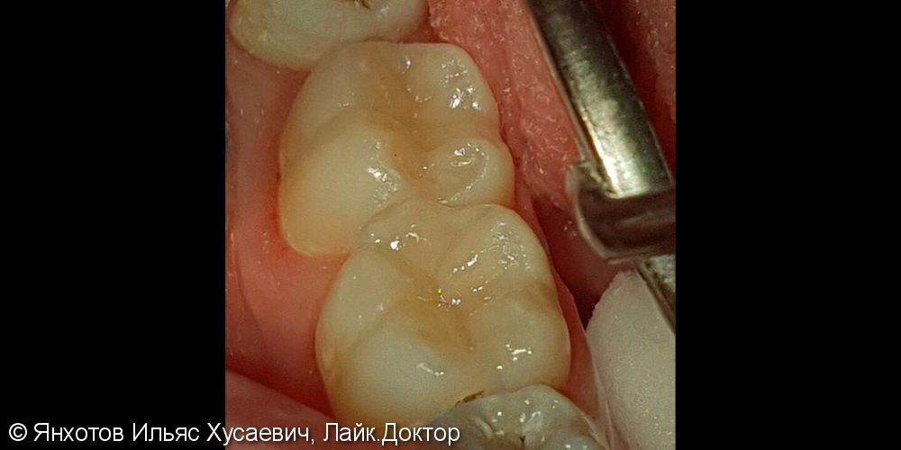 Глубокая кариозная полость зубов 4.6 и 4.7 фотографии до и после - фото №3