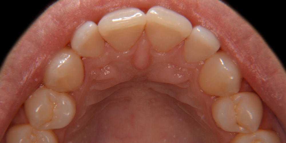 Профессиональная гигиена полости рта - фото №2