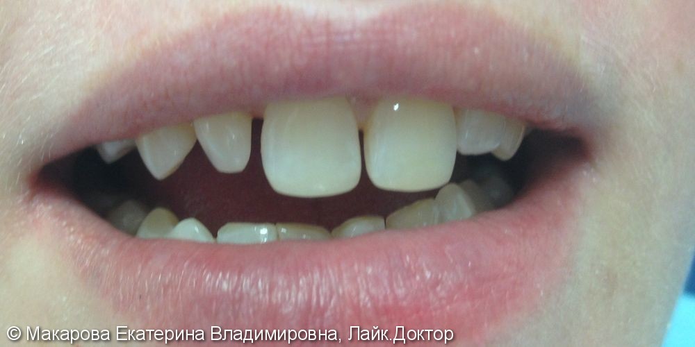 Дефект режущего края зуба 1.1 - фото №2