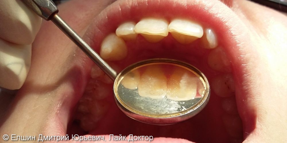 Результат чистки зубов от налета, до и после - фото №4