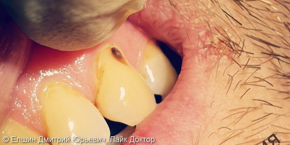 Пришеечный кариес 2.3 зуба, до и после лечения - фото №1
